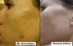 Плазмолифтинг фото
