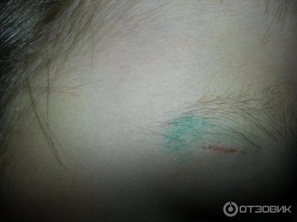 Полоски для закрытия раны Omnistrip Hartmann фото