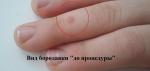 Удаление бородавок жидким азотом фото