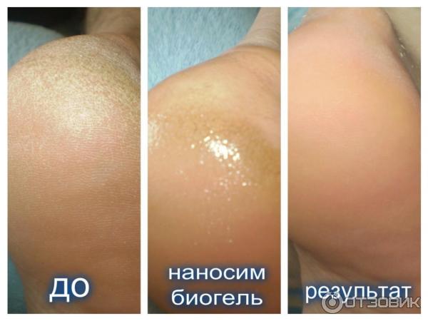 До и после применения ремувера BioGel.